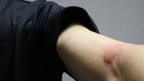 Video of mosquito bites on arm Video stock 324542205