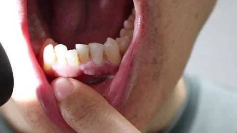 Video of a person getting their teeth checked Video stock 323501518