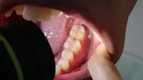 Video of a person getting their teeth checked Stock Footage 323501581