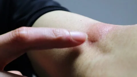 Video of a person pointing at a mosquito bite on their arm Stock Footage 324542241