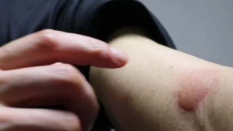 Video of a person scratching a mosquito bite on their arm Stock Footage 324542211