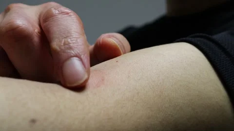 Video of a person scratching a mosquito bite on their arm Stock Footage 324542212