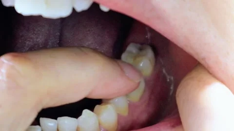 Video of a person touching a decayed tooth Stock Footage 323501735