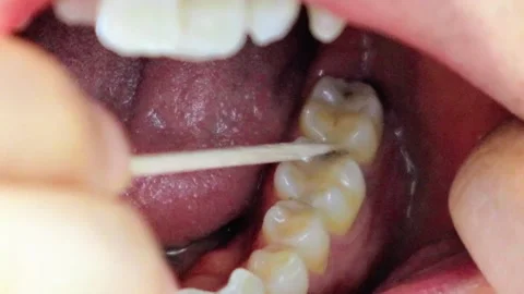 Video of a person touching a decayed tooth with a toothpick Video stock 323501746