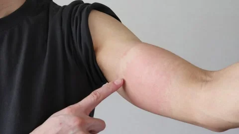 Video of a person whose skin became irritated by a supporter Video stock 326088800