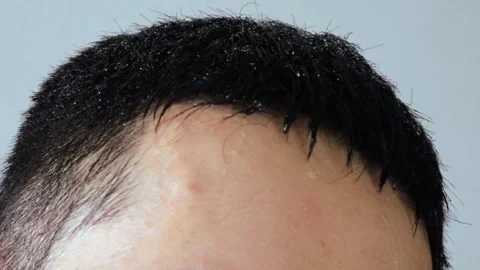 Video of a person's head sweating profusely Video stock 323502193
