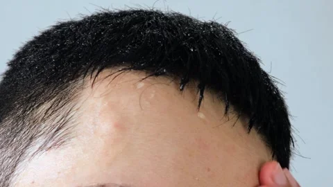 Video of a person's head sweating profusely Stock Footage 323502262