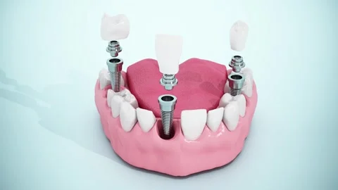 Video shows dental implants inside a half lower jaw model Stock Footage 294184532