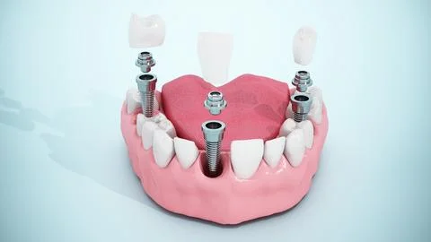 Video shows dental implants inside a half lower jaw model. 3D illustration 库存插图