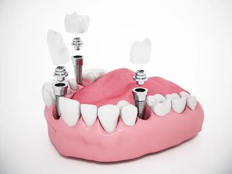 Video shows dental implants inside a half lower jaw model. 3D illustration 库存插图
