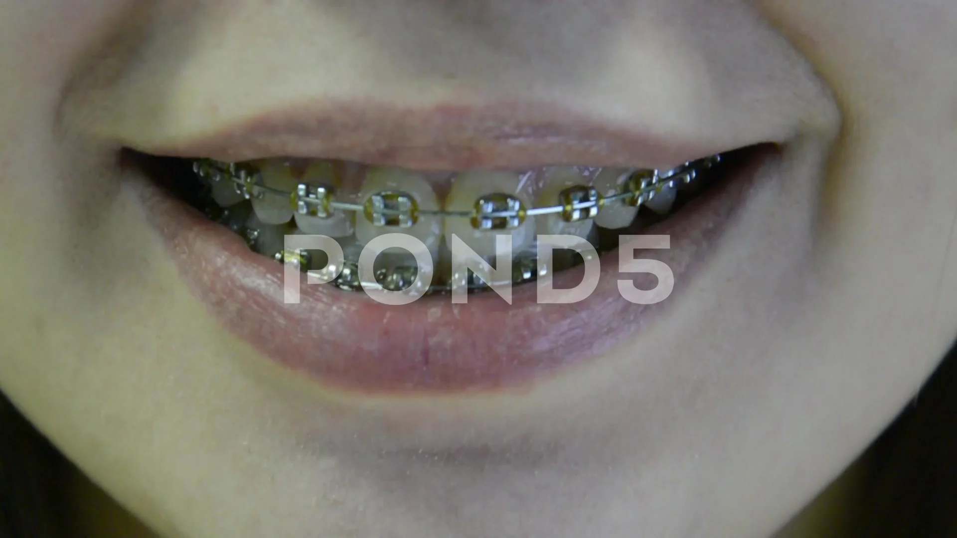Braces girl video