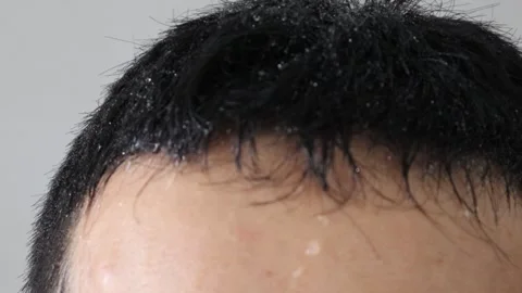Video of a sweaty person's head Video stock 323502658