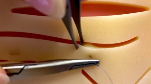 A video of wound suturing Stock Footage 315314126
