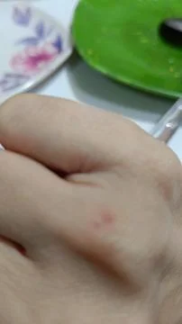 View of the back of a scratched hand 库存照片