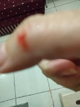 View of bleeding thumb Stock Photos