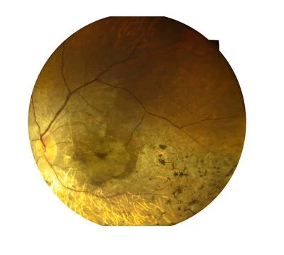 View inside human eye disorders showing retina, optic nerve and macula Severe Stock Photos