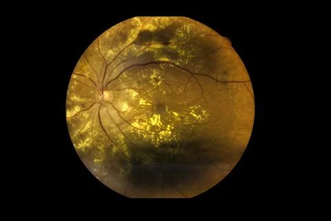 View inside human eye disorders showing retina, optic nerve and macula Severe Stock Photos