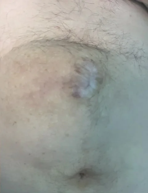 View of a Large Abdominal Wall Hernia  T21 V24 Stock Footage 218591037