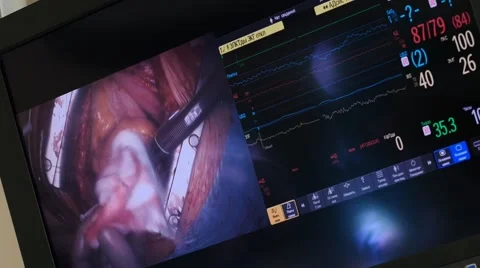 View of open heart surgery by the patient monitoring system, 4k Stock-Footage 56344238