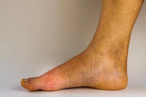 View of right old man foot, painful, redness, swollen of big toe joint. Stock Photos