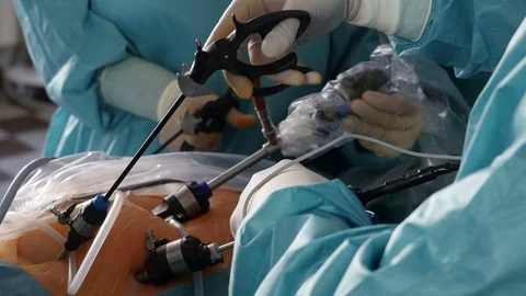 View of a surgeon team performing a laparoscopic operation, Full HD footage Video stock 74148558