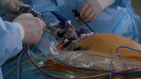 View of surgeons hands during laparoscopic surgery Video stock 127762657