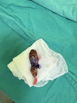 View of Surgically Removed Pilonidal Sinus SH15V25 Stock Photos