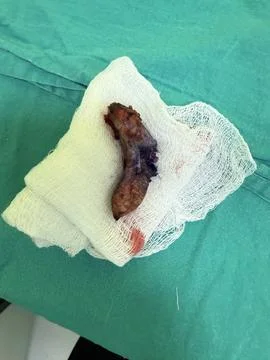 View of Surgically Removed Pilonidal Sinus SH3V25 Stock Photos