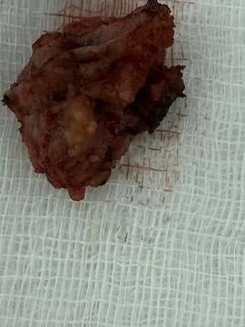 View of Surgically Removed Pilonidal Sinus T27 V25 Stock Photos