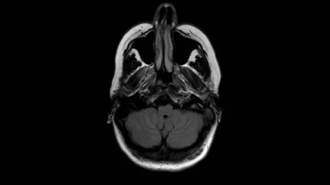View from the top. MRi of a skull. Video stock 200960043