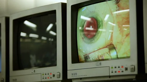 View of Two Dispays With Macro Image of Eyes During Eye Surgery. Ophthalmology Stock Footage 62510903