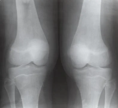 View of two human knee joints on X-ray image Stock Photos