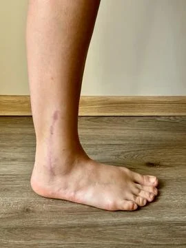 View of a woman's right leg with a post-operative healing scar on the ankle Stock Photos