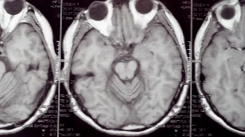 Viewing an MRI image showing a defect in the brain. Vídeos de archivo 171761227
