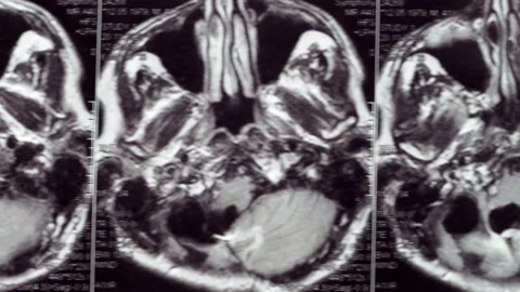 Viewing an MRI image showing a defect in the brain. 스톡 동영상 171761277