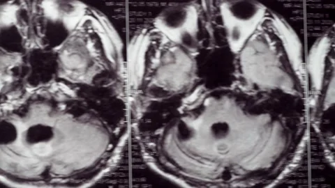 Viewing an MRI image showing a defect in the brain. 스톡 동영상 171761310