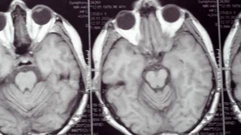 Viewing an MRI image showing a defect in the brain. Stock Footage 171761340