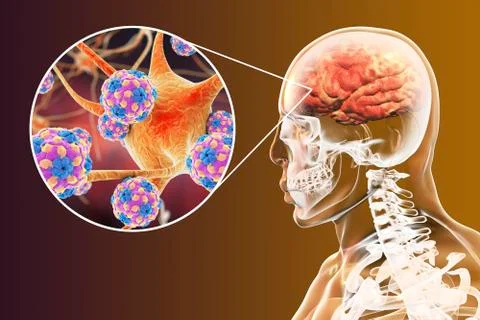Viral encephalitis, brain and neurons infected by viruses Stock Illustration