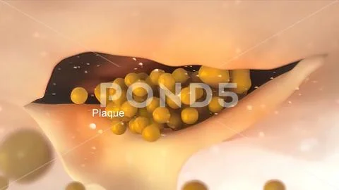 A viral plaque is a visible structure formed within a cell culture ...