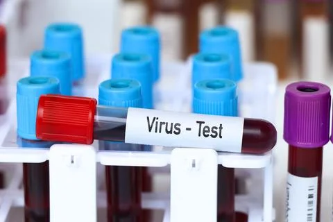 Virus test, blood sample to analyze in the laboratory Stockfoto's