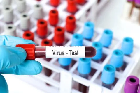 Virus test, blood sample to analyze in the laboratory Stockfoto's