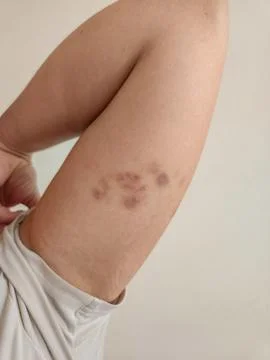 Visible bruise on the biceps Stock Photos