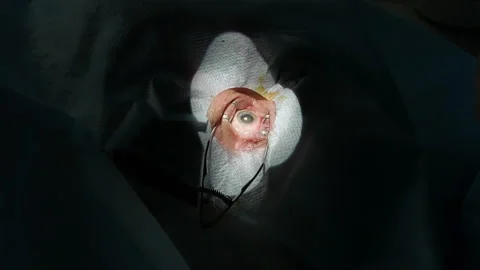 Vision correction. Close-up of a patient's eye with a surgical instrument clip Stock Footage 154135556