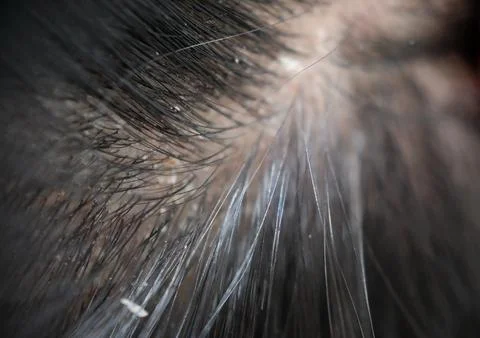 Visualizing scalp problems, white crusts and dry dandruff flakes in the hair Stock-Fotos