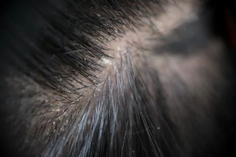 Visualizing scalp problems, white crusts and dry dandruff flakes in the hair Stock-Fotos