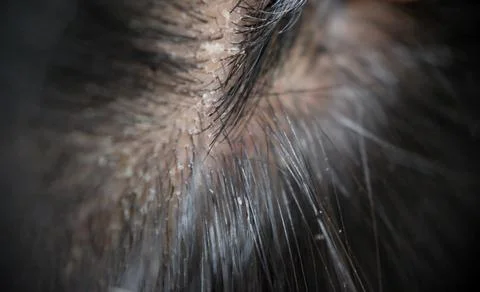 Visualizing scalp problems, white crusts and dry dandruff flakes in the hair 스톡 사진