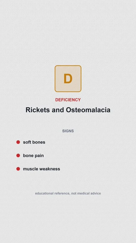 Vitamin D Deficiency Rickets and Osteomalacia Alpha 4K Vertical 9x16 Light Stockbeeldmateriaal 339519484