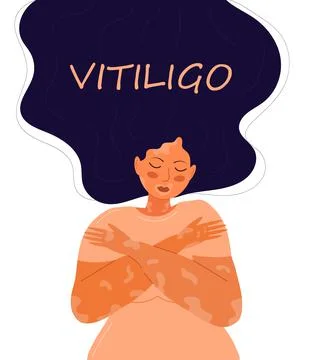 Vitiligo concept vector. World vitiligo day illustration. Disease of the skin Stock-Illustration