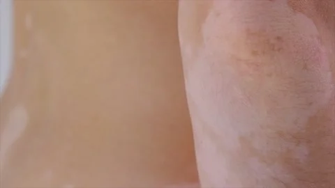 Vitiligo Stock Footage 155785321