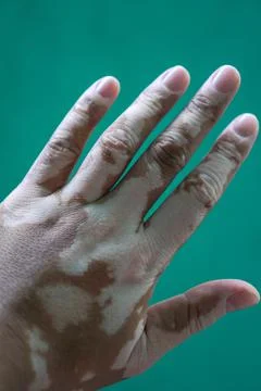 Vitiligo on the hand Stock Photos